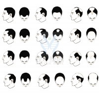 【万象城AWC(中国)基因检测】过早<font color='red'>脱发</font>、掉发太多怎么办？你的方法可能是错的！